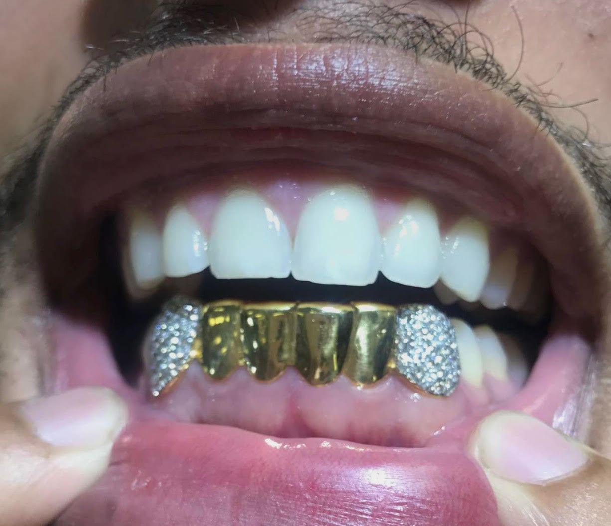 6 PIECE GOLD with 2 VS NATURAL DIAMOND FANGS